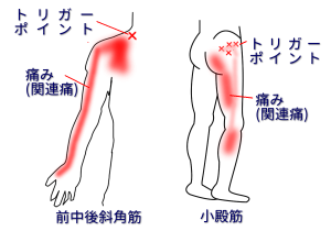 肩と殿部にできたトリガーポイントにより引き起こされる関連痛の例
